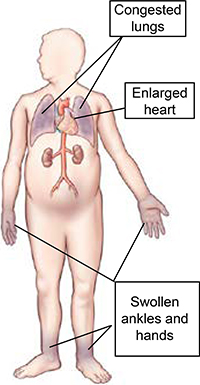 Body diagram of heart failure symptoms.